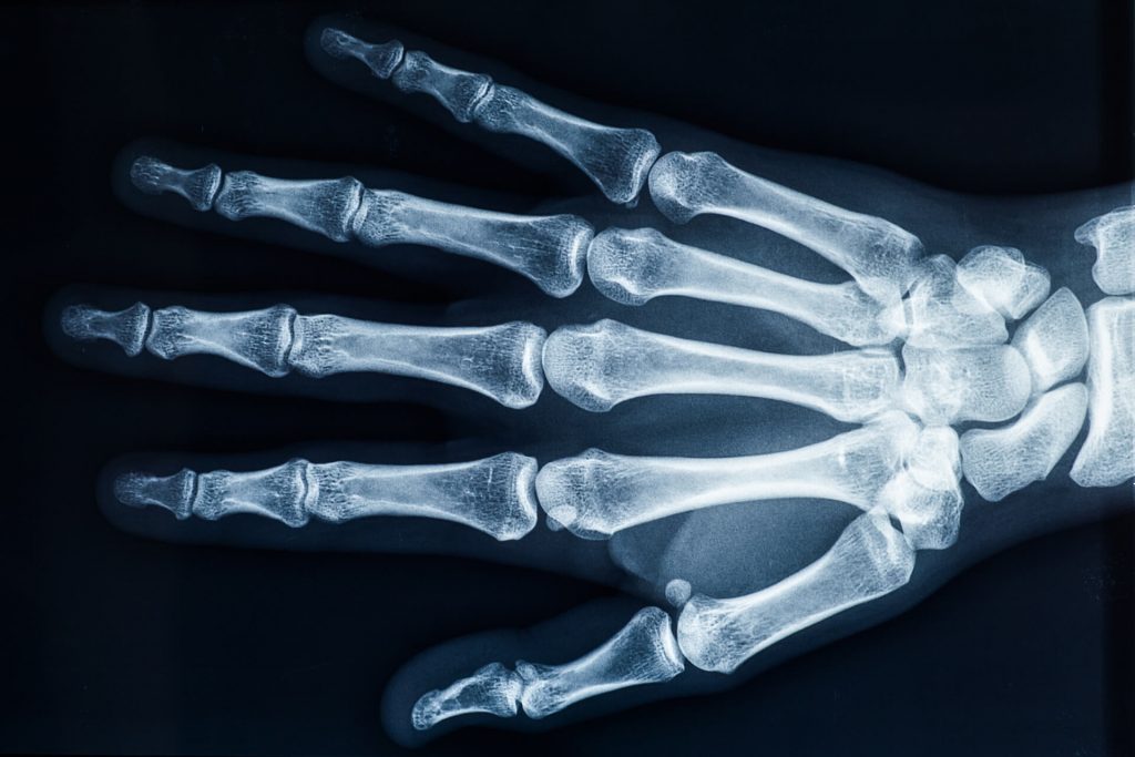 Finger Arthritis | Action Rehab - Shoulder, Elbow, Wrist and Hand Physiotherapists Scaphoid Fractures Xray