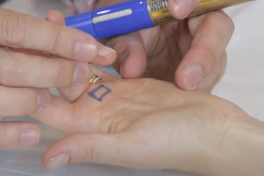 Trigger Finger and Pregnancy | Action Rehab