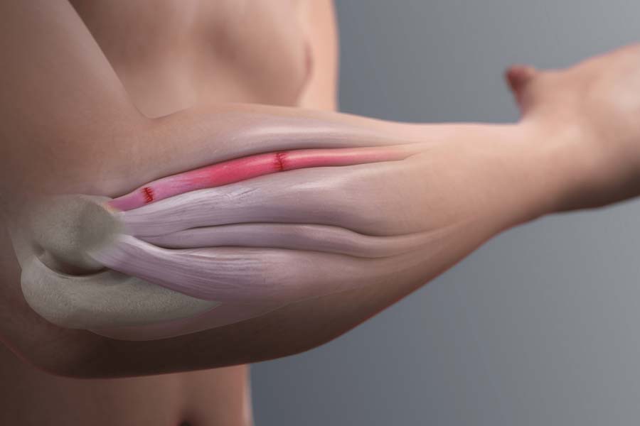 Tennis Elbow | Action Rehab - Shoulder, Elbow, Wrist and Hand Physiotherapists Tennis Elbow Treatment Melbourne