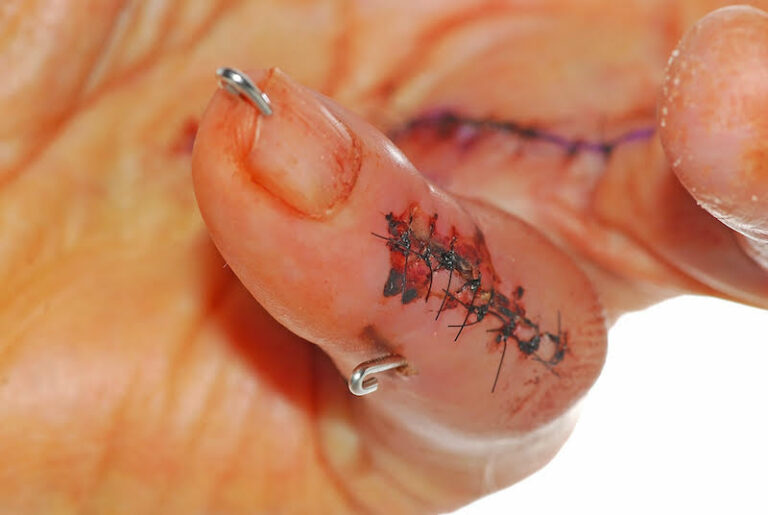 Central Slip Injury | Action Rehab - Shoulder, Elbow, Wrist and Hand Physiotherapists Tendon Injury - Central Slip Injury