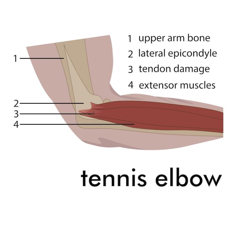 Tennis Elbow | Action Rehab - Shoulder, Elbow, Wrist and Hand Physiotherapists Tennis Elbow | Action Rehab