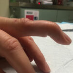 Mallet Finger Swan Neck Injury | Action Rehab