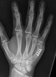 Metacarpal Fracture | Action Rehab - Shoulder, Elbow, Wrist and Hand Physiotherapists Metacarpal Fracture Xray | Action Rehab