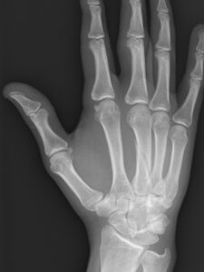 Metacarpal Fracture | Action Rehab - Shoulder, Elbow, Wrist and Hand Physiotherapists Metacarpal Fracture Xray | Action Rehab