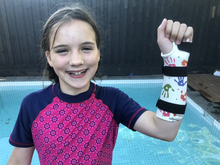 Broken Wrist - Colles' Fracture | Action Rehab - Shoulder, Elbow, Wrist and Hand Physiotherapists Waterproof Splints and Casts | Action Rehab