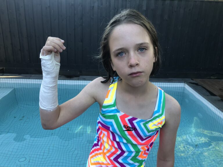 Greenstick or Paediatric Buckle Fracture | Action Rehab - Shoulder, Elbow, Wrist and Hand Physiotherapists Pop Casts for Fractures | Action Rehab