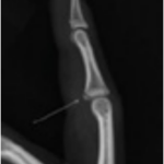 Finger Dislocation Volar Plate Xray
