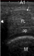 Trigger Finger Ultrasound