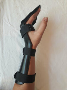Wrist & Forearm Injury Splinting | Action Rehab