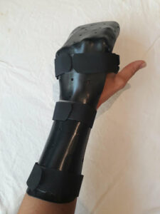 Wrist & Forearm Injury Splinting | Action Rehab