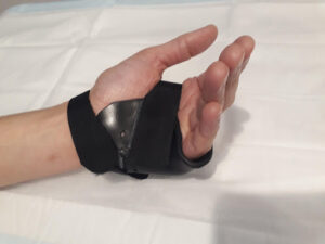Custom Splints and Casts for Injuries | Action Rehab