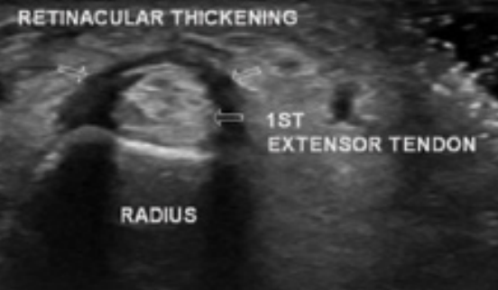 De Quervain's Tenosynovitis Xray