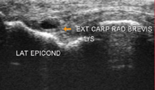 Tennis Elbow | Action Rehab - Shoulder, Elbow, Wrist and Hand Physiotherapists Tennis Elbow Xray | Action Rehab