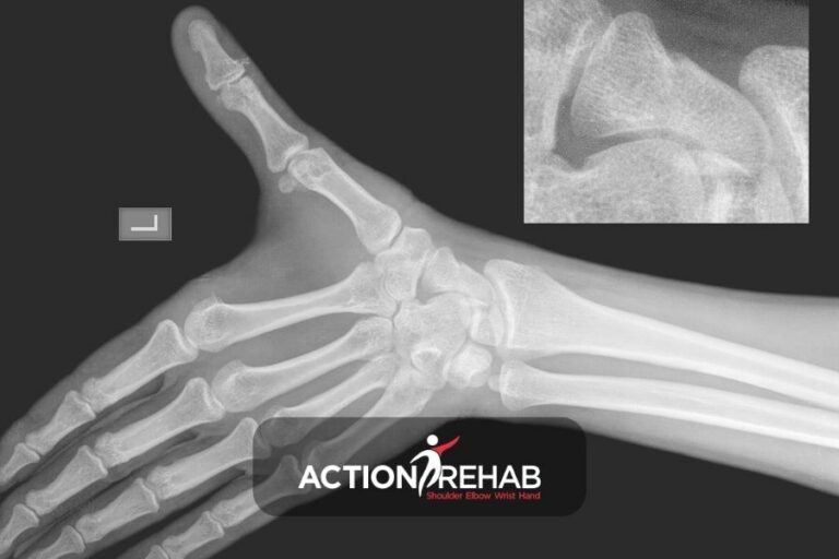 How to treat a Scaphoid fracture | Action Rehab - Shoulder, Elbow, Wrist and Hand Physiotherapists Scaphoid Fracture | Action Rehab