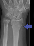 Broken Wrist - Colles' Fracture | Action Rehab - Shoulder, Elbow, Wrist and Hand Physiotherapists Distal-Radius-Fracture-Imaging