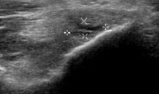 Golfers Elbow Imaging