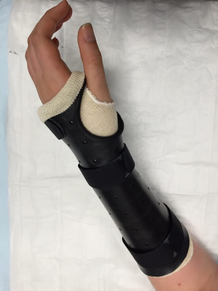 Casting and Splinting, Fracture Casting