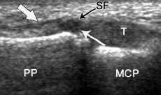 Thumb MCPJ UCL RCL Imaging