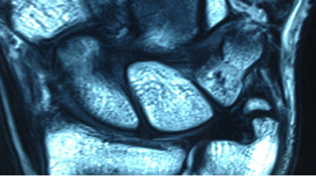 Hand Injury Xray | Action Rehab