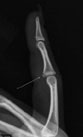 Sprained or Fractured Fingers | Action Rehab - Shoulder, Elbow, Wrist and Hand Physiotherapists Volar Plate Avulsion Fracture