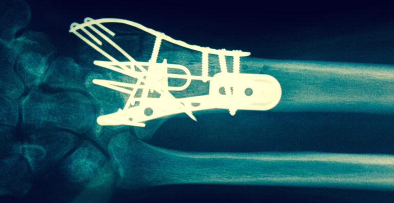Broken Wrist - Colles' Fracture | Action Rehab - Shoulder, Elbow, Wrist and Hand Physiotherapists Wrist Xray | Action Rehab