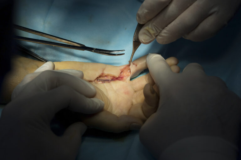 Tendon Injury - Jersey Finger | Action Rehab - Shoulder, Elbow, Wrist and Hand Physiotherapists Hand Surgery Melbourne | Action Rehab