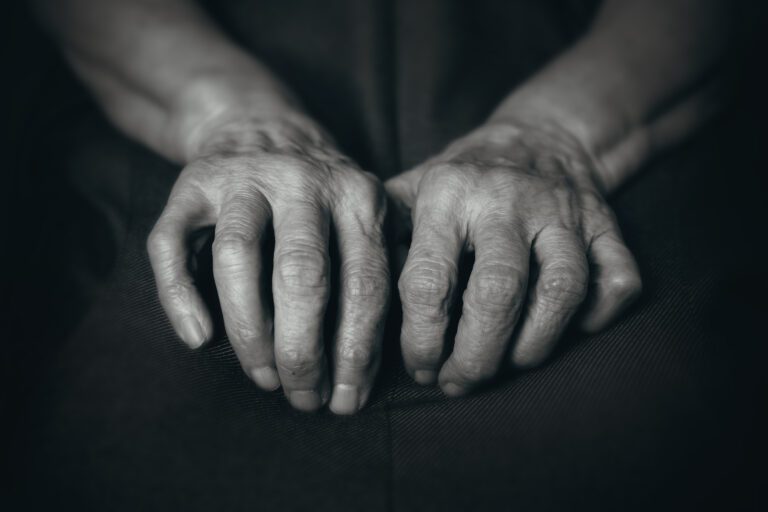 Finger Arthritis | Action Rehab - Shoulder, Elbow, Wrist and Hand Physiotherapists Old Man's Palms