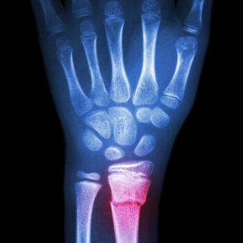 Fracture Distal Radius (forearm’s Bone) Wrist Fracture Xray - Fracture Distal Radius | Action Rehab