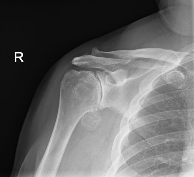 Frozen Shoulder Treatment Melbourne | Action Rehab