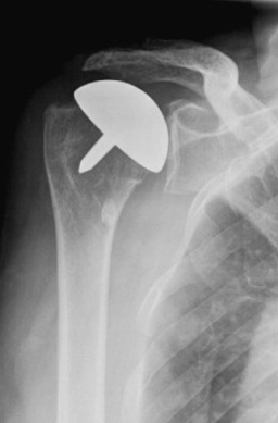 Shoulder Replacement | Action Rehab - Shoulder, Elbow, Wrist and Hand Physiotherapists