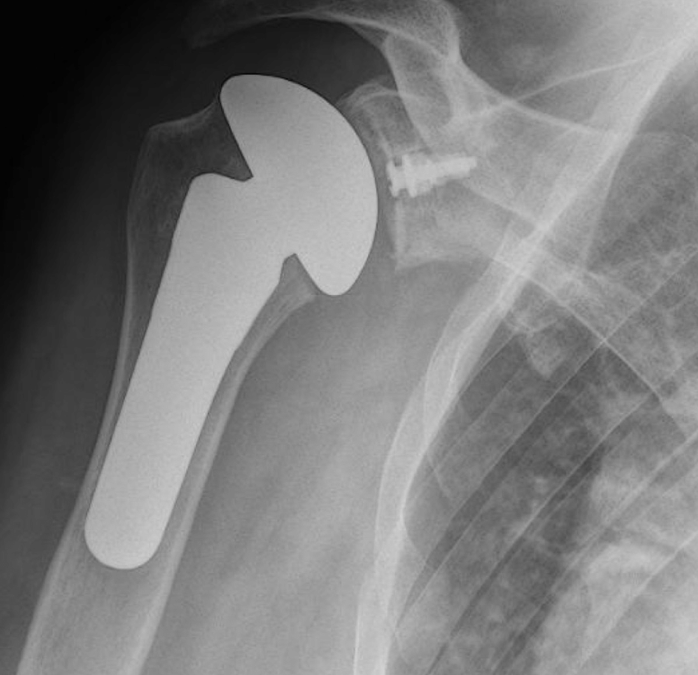 Shoulder Replacement | Action Rehab - Shoulder, Elbow, Wrist and Hand Physiotherapists