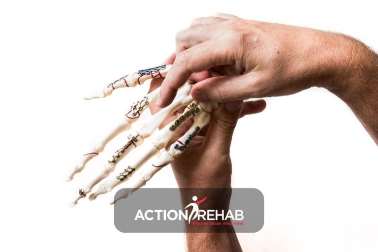 Volar Plate Injuries | Action Rehab - Shoulder, Elbow, Wrist and Hand Physiotherapists Finger Volar Plate Injury Therapist Drouin | Action Rehab