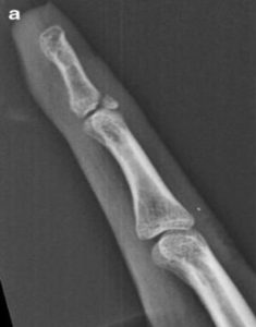 Understanding Mallet Finger: Causes, Symptoms, and Treatment Options | Action Rehab - Shoulder, Elbow, Wrist and Hand Physiotherapists Understanding Mallet Finger: Causes, Symptoms, and Treatment Options