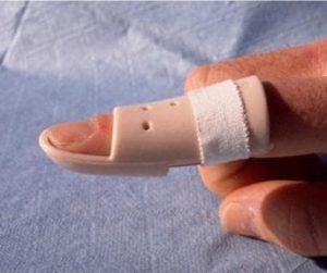 Understanding Mallet Finger: Causes, Symptoms, and Treatment Options | Action Rehab - Shoulder, Elbow, Wrist and Hand Physiotherapists Mallet Finger Splint - Hand Physiotherapy | Action Rehab Hand Physiotherapist