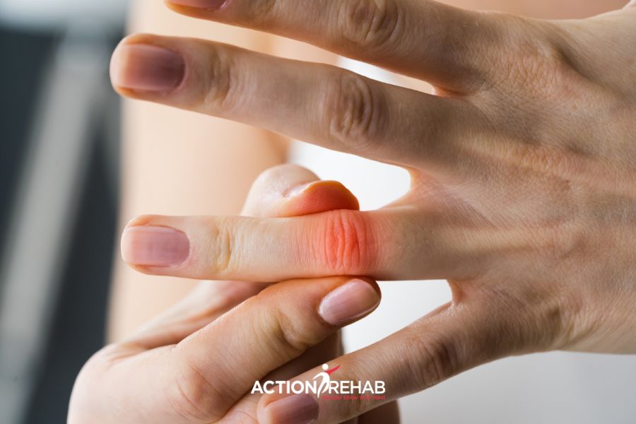 Drouin hand therapist for volar plate injury | action rehab