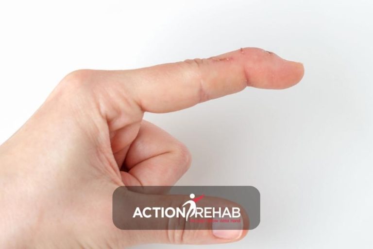 Understanding Mallet Finger: Causes, Symptoms, and Treatment Options | Action Rehab - Shoulder, Elbow, Wrist and Hand Physiotherapists Hand Splint for Mallet Finger | Action Rehab Hand Therapist