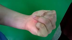 Post-Operative Flexor Tendon Rehab of the Hand | Action Rehab - Shoulder, Elbow, Wrist and Hand Physiotherapists Post-Operative Flexor Tendon Rehab of the Hand