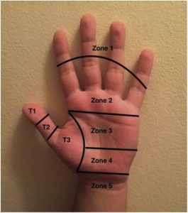 Post-Operative Flexor Tendon Rehab of the Hand | Action Rehab - Shoulder, Elbow, Wrist and Hand Physiotherapists Post-Operative Flexor Tendon Rehab of the Hand