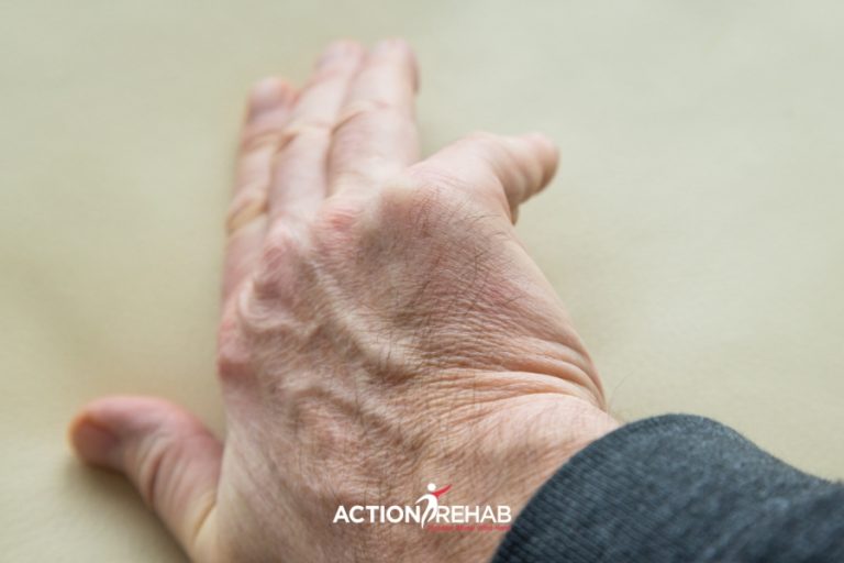 Managing Dupuytren's Disease and Contracture | Action Rehab - Shoulder, Elbow, Wrist and Hand Physiotherapists Managing Dupuytren's Disease and Contracture