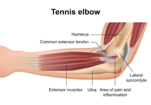 Management and Recovery of Lateral Epicondylitis (Tennis Elbow) | Action Rehab Hand Therapy