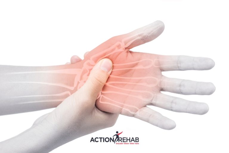 Metacarpal Fractures: Understanding Causes and Recovery Strategies | Action Rehab - Shoulder, Elbow, Wrist and Hand Physiotherapists Metacarpal Fractures Understanding Causes and Recovery Strategies | Action Rehab Hand Therapy