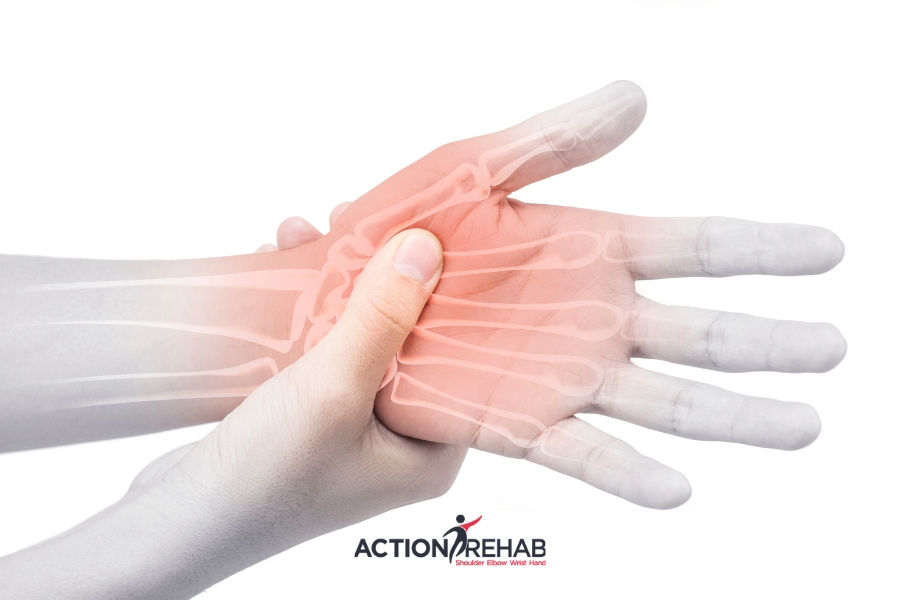 Metacarpal Fractures Understanding Causes and Recovery Strategies | Action Rehab Hand Therapy