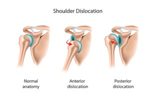 Shoulder dislocation rehabilitation with physiotherapy | action rehab hand therapy