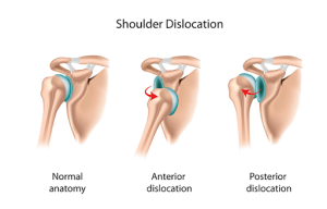Shoulder Dislocation Rehabilitation with Physiotherapy | Action Rehab Hand Therapy