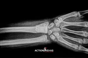 How to Treat a Distal Radius Fracture | Action Rehab Hand Therapy