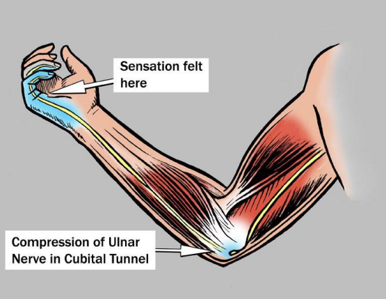 Cubital Tunnel Syndrome Explained: Why Your Ring & Little Fingers Feel Numb | Action Rehab - Shoulder, Elbow, Wrist and Hand Physiotherapists Cubital Tunnel Syndrome Explained: Why Your Ring & Little Fingers Feel Numb | Action Rehab - Shoulder, Elbow, Wrist and Hand Physiotherapists