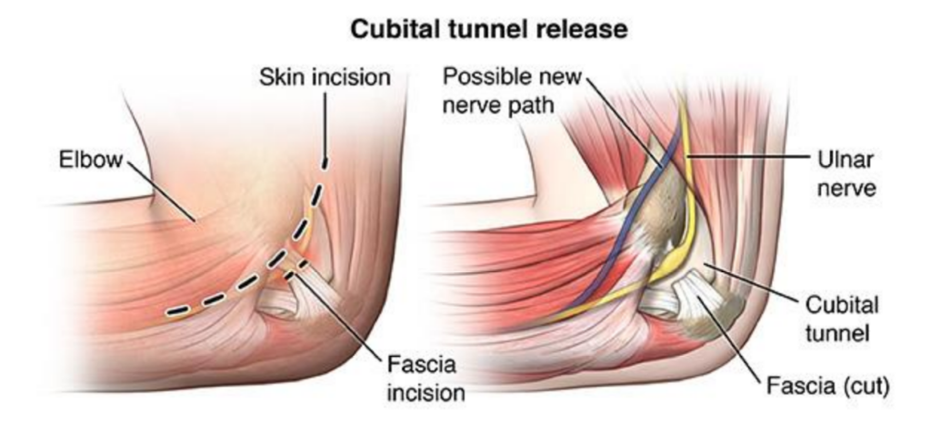 Cubital Tunnel Syndrome Explained: Why Your Ring & Little Fingers Feel Numb | Action Rehab - Shoulder, Elbow, Wrist and Hand Physiotherapists Cubital Tunnel Syndrome Explained: Why Your Ring & Little Fingers Feel Numb | Action Rehab - Shoulder, Elbow, Wrist and Hand Physiotherapists