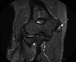 GOLFER’S ELBOW (MEDIAL EPICONDYLITIS) | Action Rehab - Shoulder, Elbow, Wrist and Hand Physiotherapists GOLFER’S ELBOW (MEDIAL EPICONDYLITIS) | Action Rehab - Shoulder, Elbow, Wrist and Hand Physiotherapists