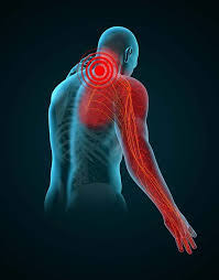 Cervical Radiculopathy | Action Rehab - Shoulder, Elbow, Wrist and Hand Physiotherapists Cervical Radiculopathy | Action Rehab - Shoulder, Elbow, Wrist and Hand Physiotherapists