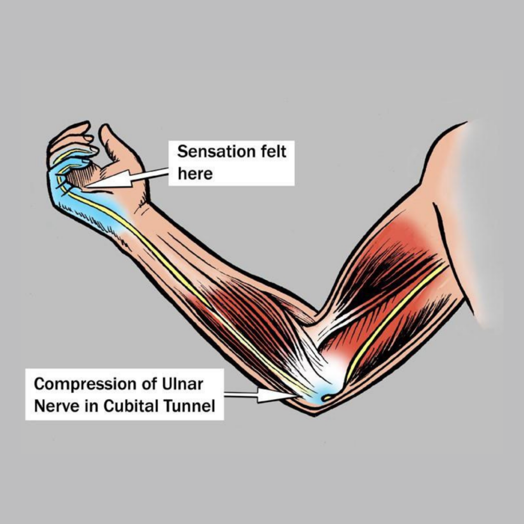 Is Your Phone Causing Thumb or Wrist Pain? Common Conditions and How to Manage Them | Action Rehab - Shoulder, Elbow, Wrist and Hand Physiotherapists